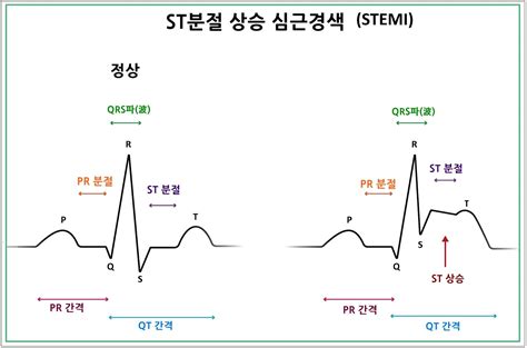 비 ST 분절 상승 심근경색증의 예후인자로서 ST분절 하강 점수 - st 분절